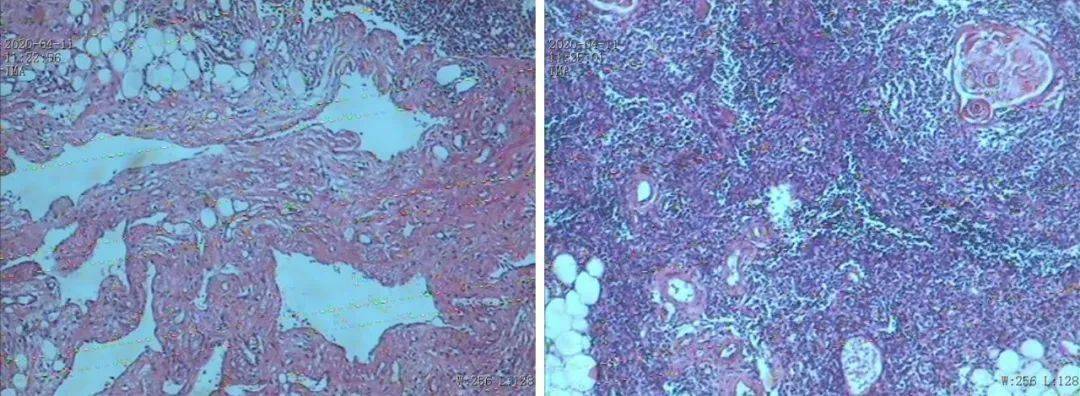 李春华等:胸导管变异的纵隔囊性淋巴管瘤1例——个案报道|cjts杂志