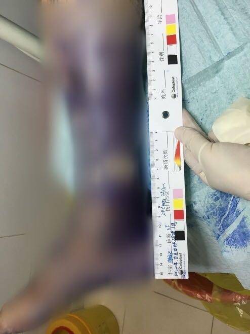 碘酒|糖尿病人给伤口涂紫药水 医生：别用了！盖住伤口还耽误治疗