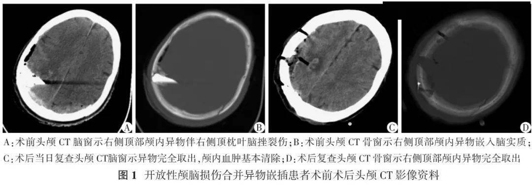 開放性顱腦損傷早期臨床救治策略 | 中華神經創傷