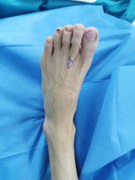 高敏华|男子失拇指医生用脚趾补