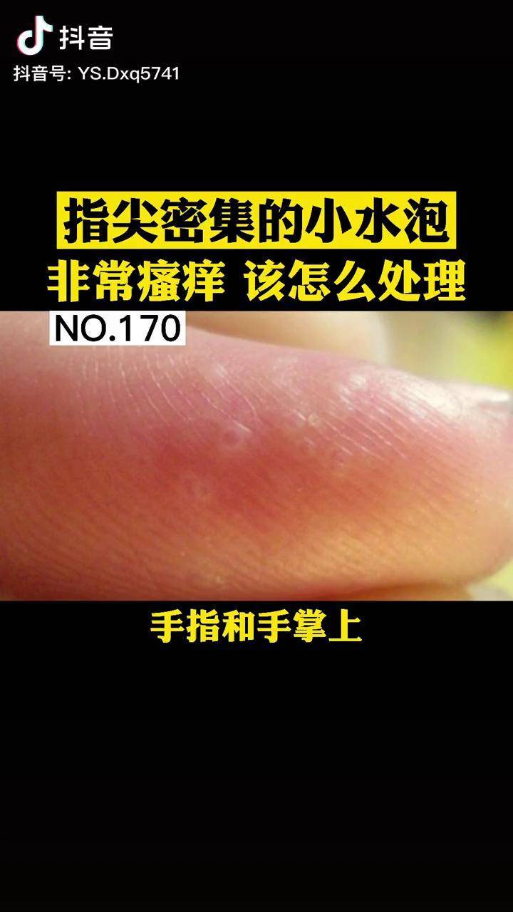 手指手指出现针尖大小的小水泡非常痒该如何处理呢汗疱疹湿疹