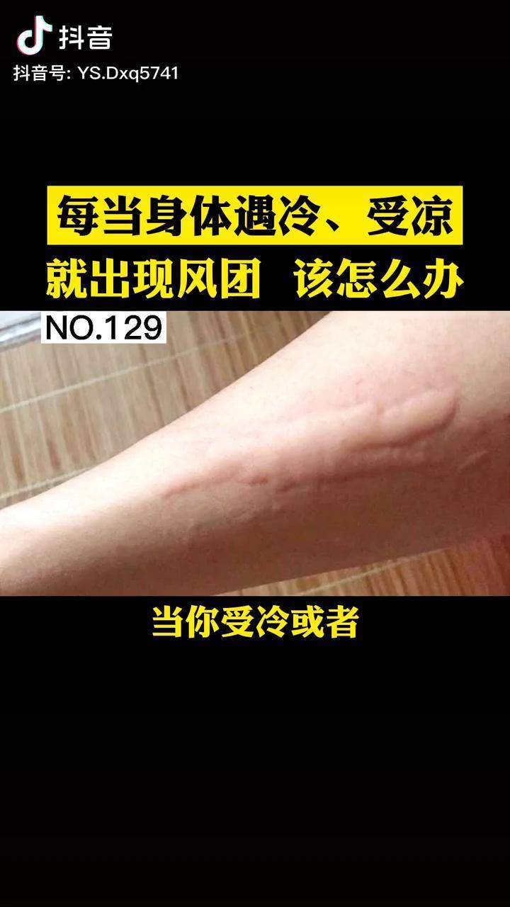 寒冷性荨麻疹