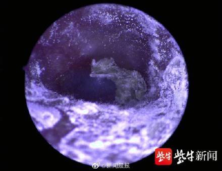 真菌|耳道查出灰白色霉菌，南京女子频繁掏耳致耳朵发霉？！