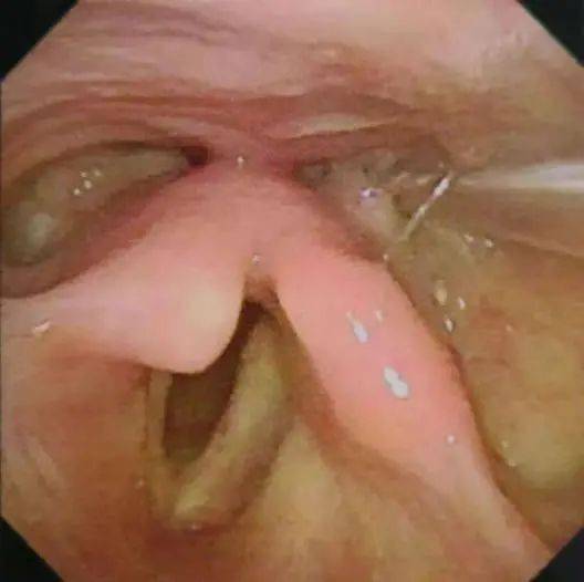 合并|规培医师视角下的多学科协作困难鼻胃管置入