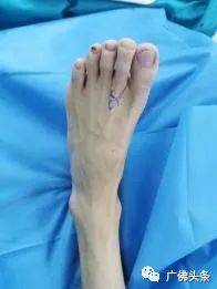 复活|妙手回春！脚趾移植到手上变大拇指，男子断指成功“复活”