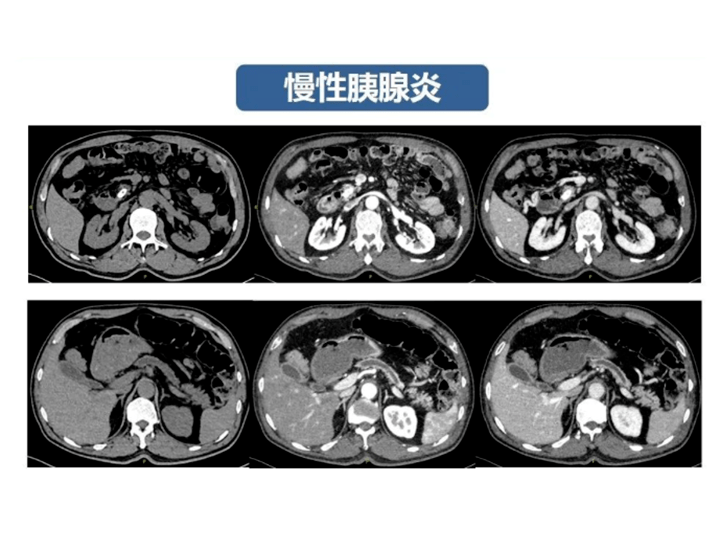 慢性胰腺炎CT图片