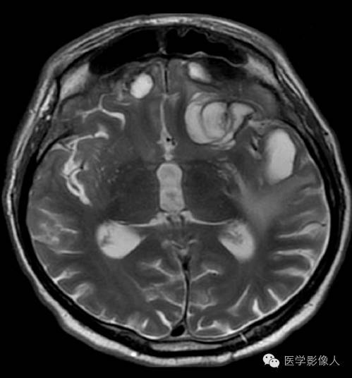 黄素环|脑内T2WI上低信号病变大致分为8大类【总结】