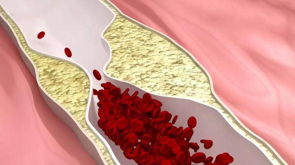 诊断|收藏!高血压的三大误区和治疗方法