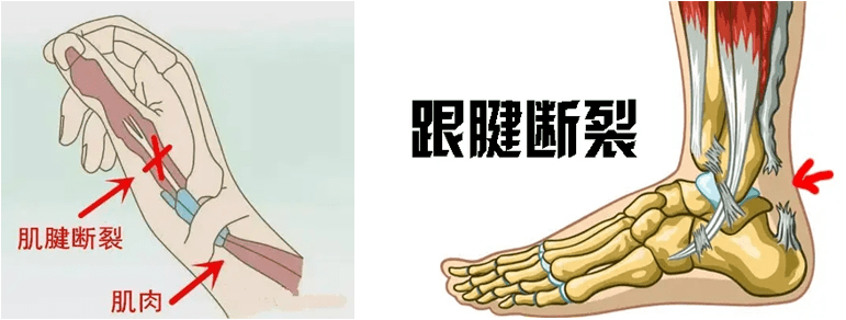 肌腱断裂后为什么要用石膏固定呢 部分 肌腱断裂后为什么要用石膏固定呢 部分