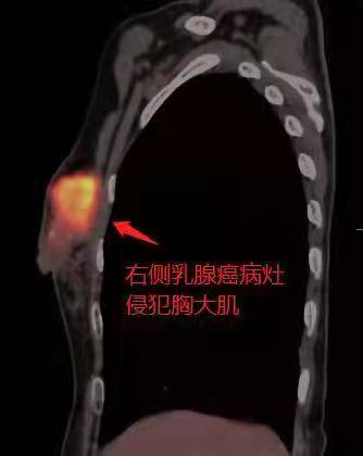 广州|肿瘤涨大八倍却难手术，广州医生为肺功能不足患者成功摘瘤