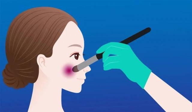 效果|开颅、断骨、切神经……这是医美，还是“酷刑”？