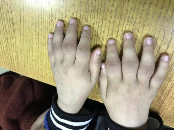4岁男孩也中招_指关节