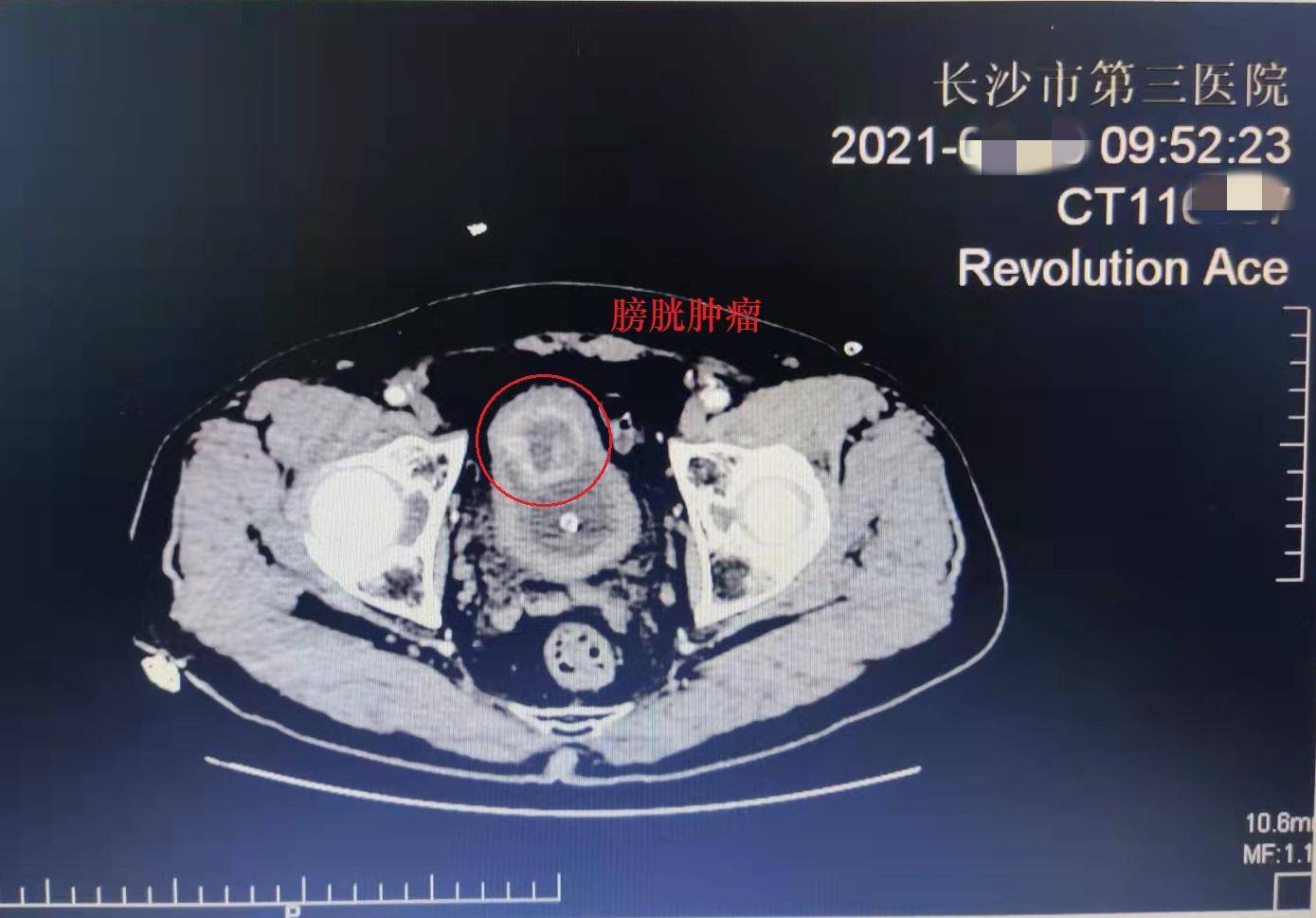 66岁爷爷小便尿出鲜血和黑色血块,血压直冲200  ,问题出在这里