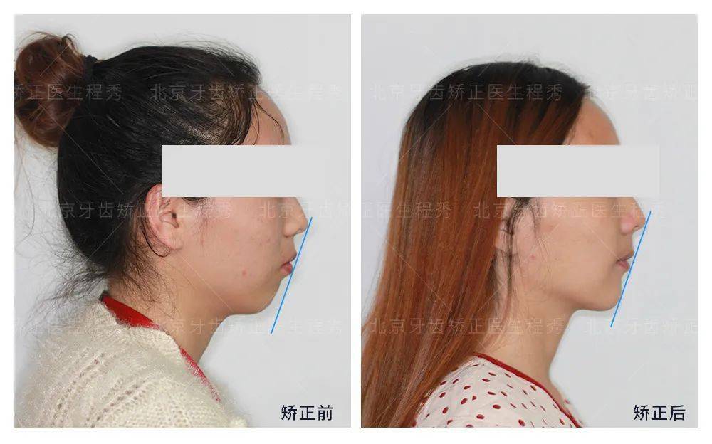 不动刀三招提升颜值拥有下巴