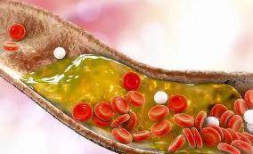 血栓|打喷嚏打出脑梗，竟跟这种常见病有关？