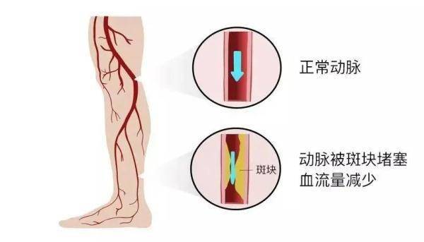 感觉|它是心梗、脑梗的元凶，更容易找上这些人
