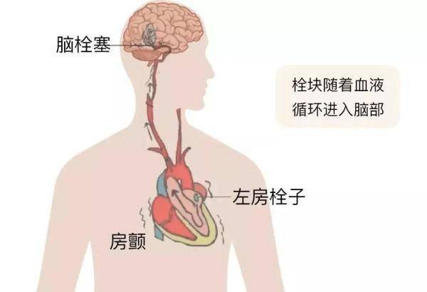 感觉|它是心梗、脑梗的元凶，更容易找上这些人