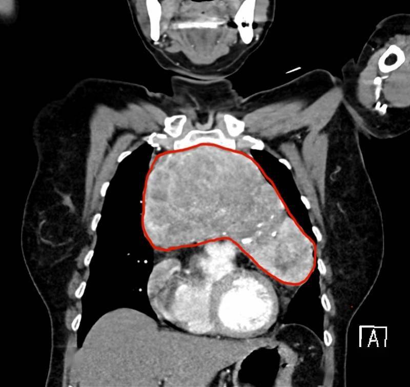 团队|甲状腺肿深入胸腔“顶心顶肺”，团队携手为老太胸口卸肿物