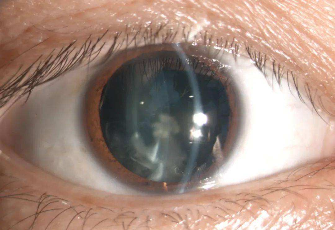 做了详细的眼部检查,发现陈先生右眼除了外伤性白内障伴晶状体半脱位