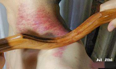 神奇的擀筋疗法擀走各类不适擀来健康