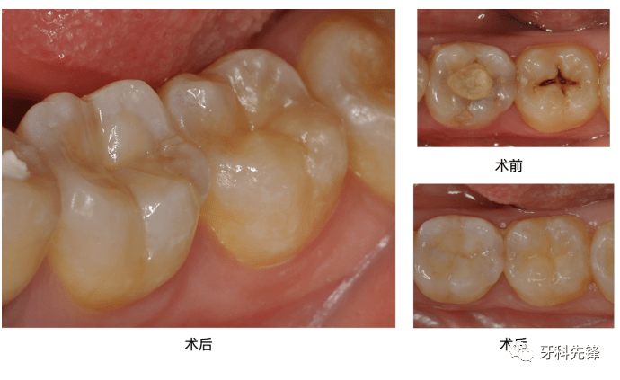 术后照片术后照片充填即刻光固化牙本质堆塑洞衬选择性酸蚀颊牙合面龋