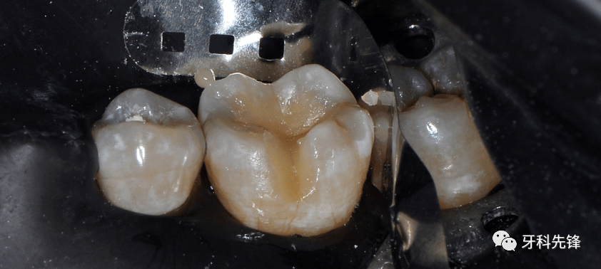 病例后牙美塑充填