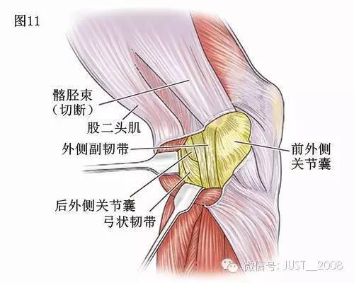 圖11 膝關節外側面,第三層由外側關節囊構成.