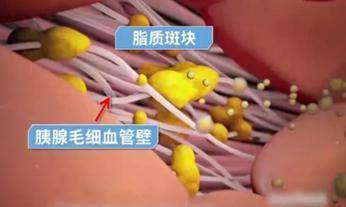 株洲|凶险的急性胰腺炎，起因竟是小小的胆结石？