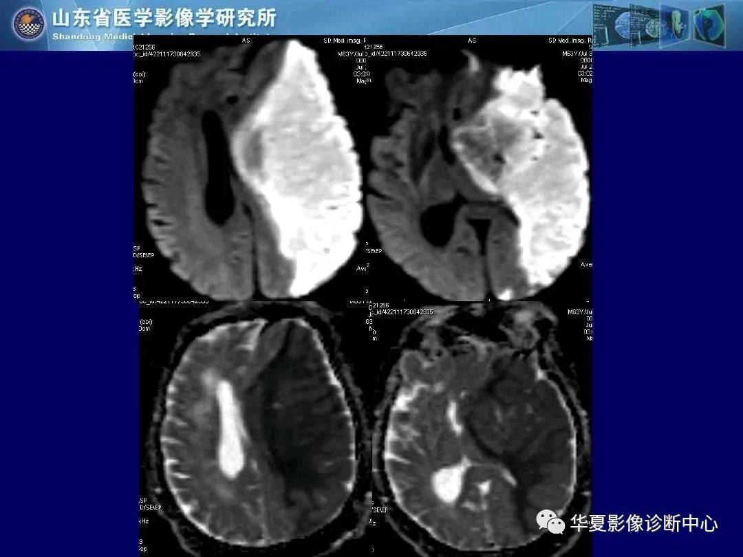 诊断|缺血性脑血管病的影像诊断