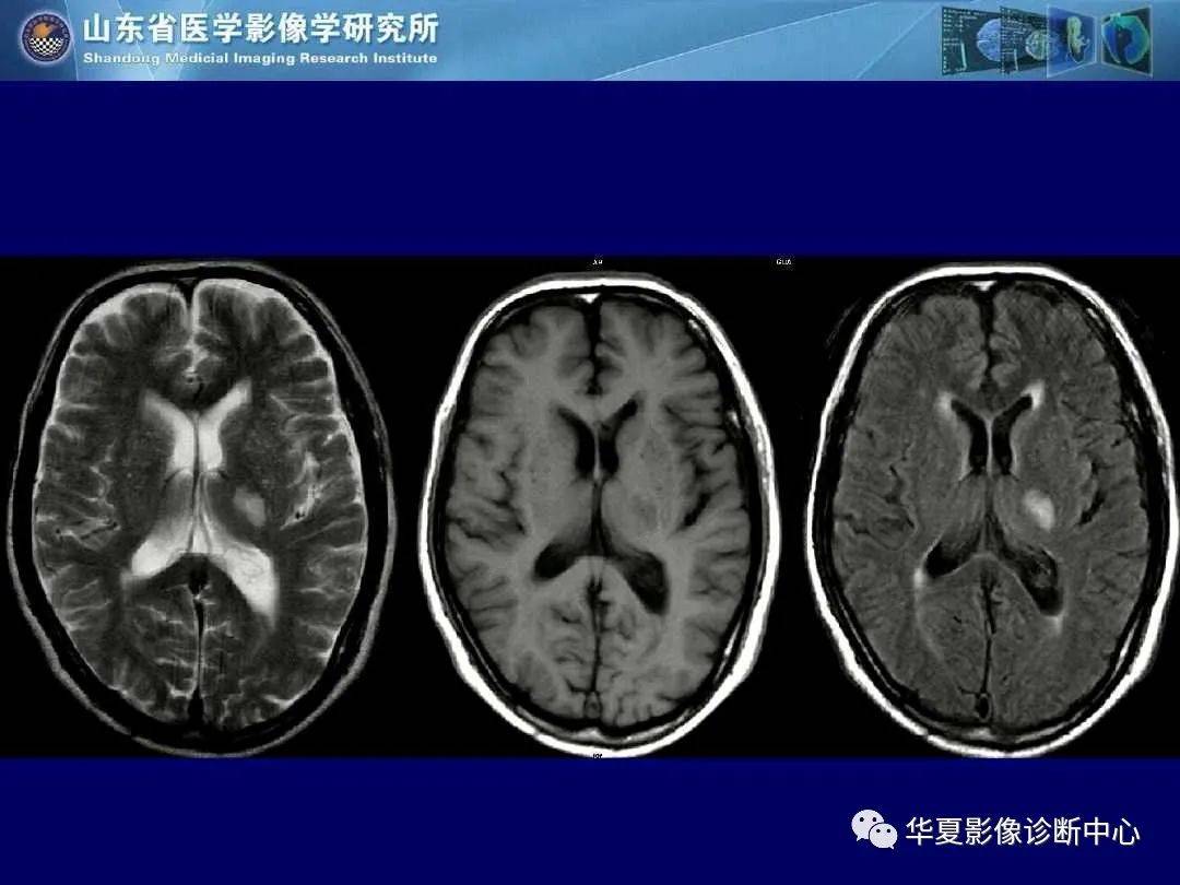 诊断|缺血性脑血管病的影像诊断