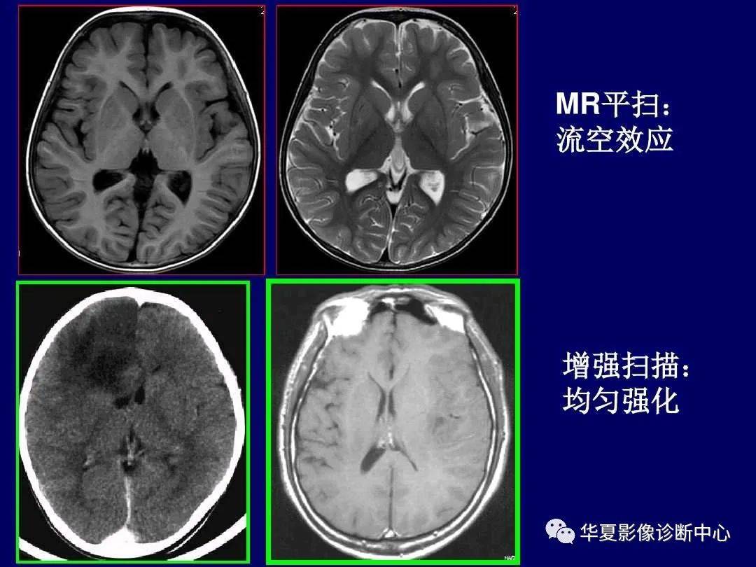 诊断|缺血性脑血管病的影像诊断