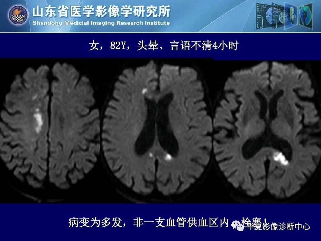 诊断|缺血性脑血管病的影像诊断