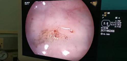 寄生虫|警惕！女孩肠道内诱发“虫病” 只因爱吃这类食物