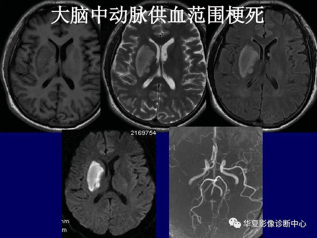 诊断|缺血性脑血管病的影像诊断