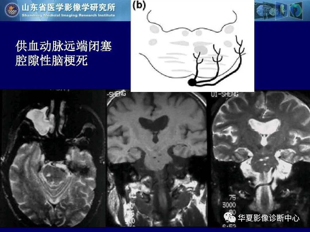 诊断|缺血性脑血管病的影像诊断