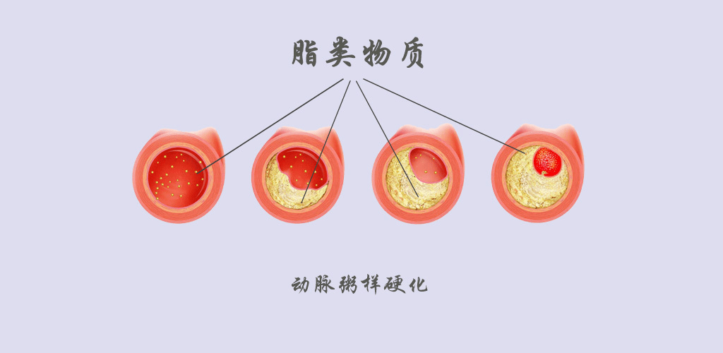 冠状动脉解剖图钙化图片