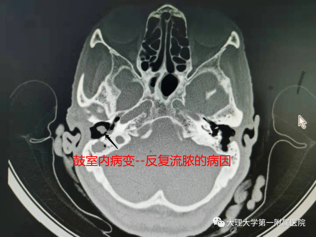 共取出約20餘條活體蠅蛆!