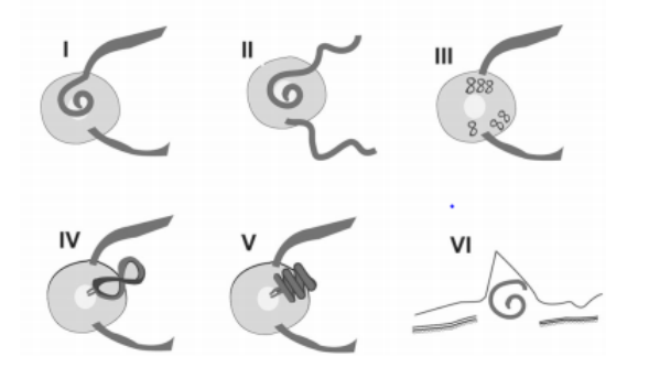 视乳头前血管袢的临床诊疗特点