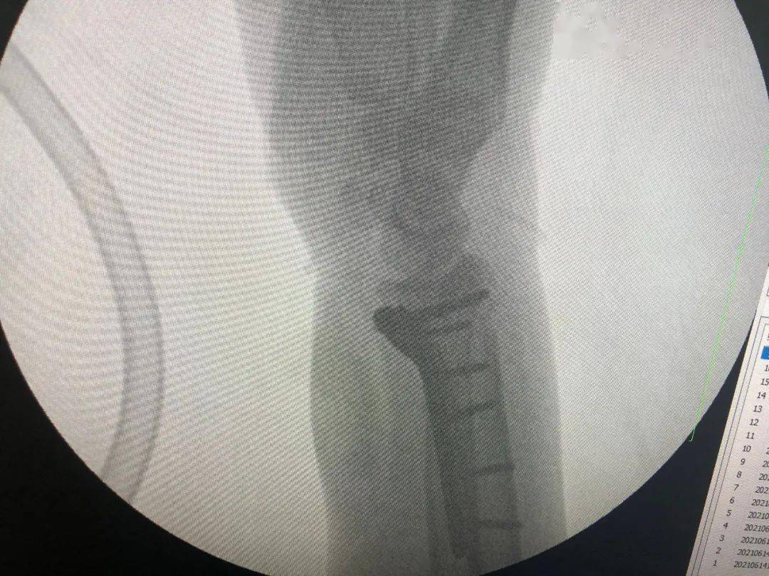 桡骨远端骨折,关节面塌陷:行切开复位钢板内固定术胸腰椎压缩骨折(男