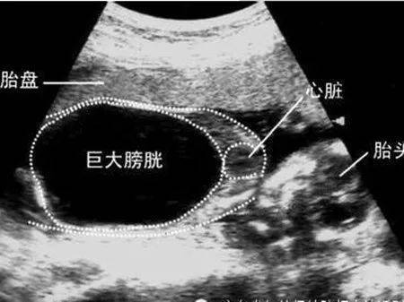 胎儿巨膀胱:不仅仅是膀胱大那么简单!