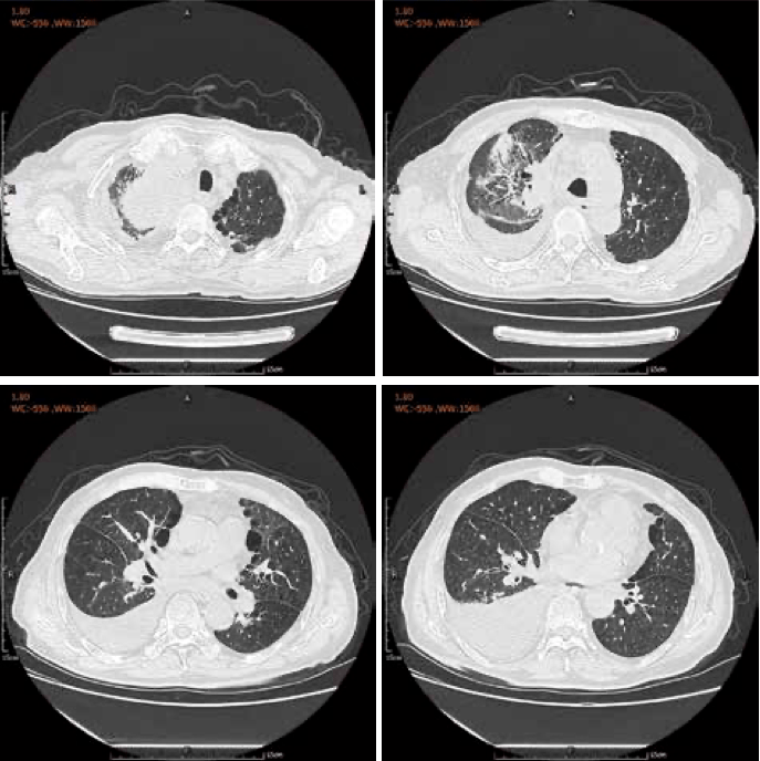 肺癌患者治疗选择困难重重肿瘤重度免疫治疗相关不良反应病例集萃及