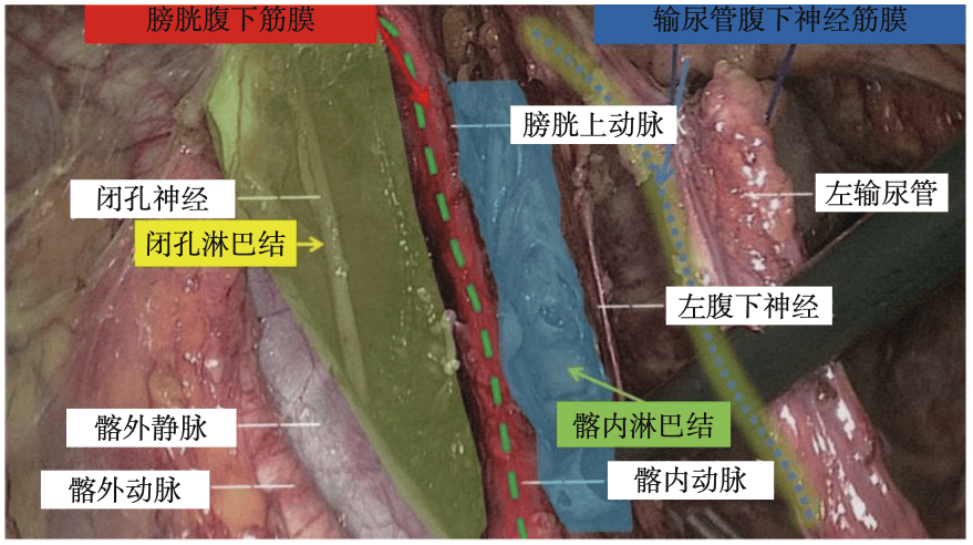 一,低位直腸癌側方淋巴結清掃原因,範圍