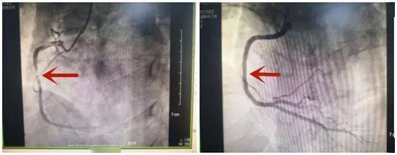 心脑血管|苏州一天近百人中招！医生紧急提醒：这几类人千万注意！