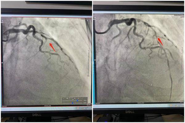 心脑血管|苏州一天近百人中招！医生紧急提醒：这几类人千万注意！
