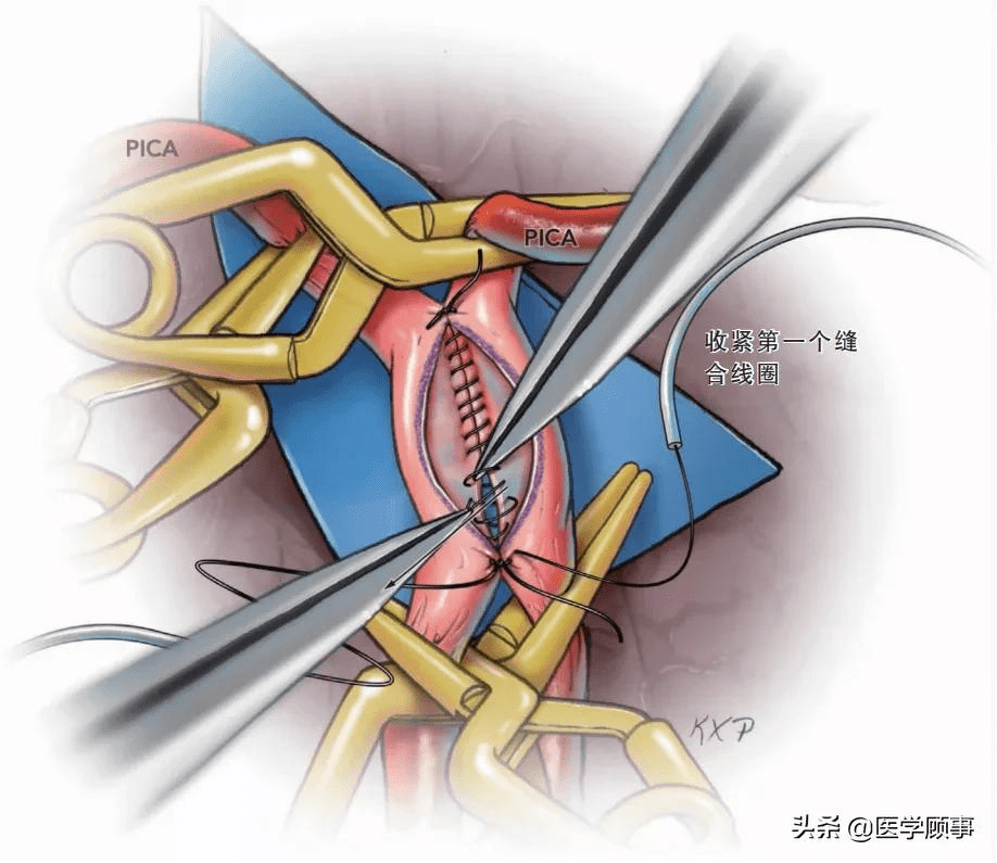 腦血管側-側吻合技術_動脈