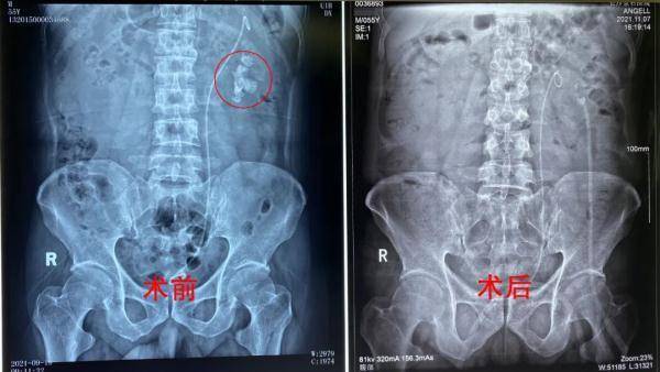 肾脏|男子曾因结石右肾萎缩，今尿血就医发现左肾又长满结石