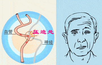 面部|天冷易诱发面瘫，这些症状要注意！