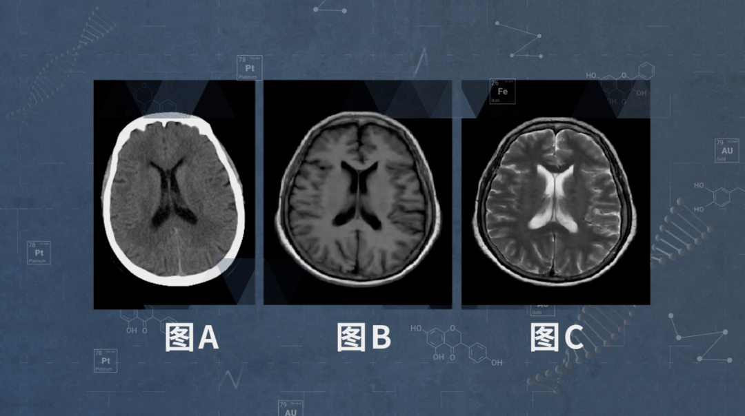 一文带您读懂ct和磁共振报告中的癌信号