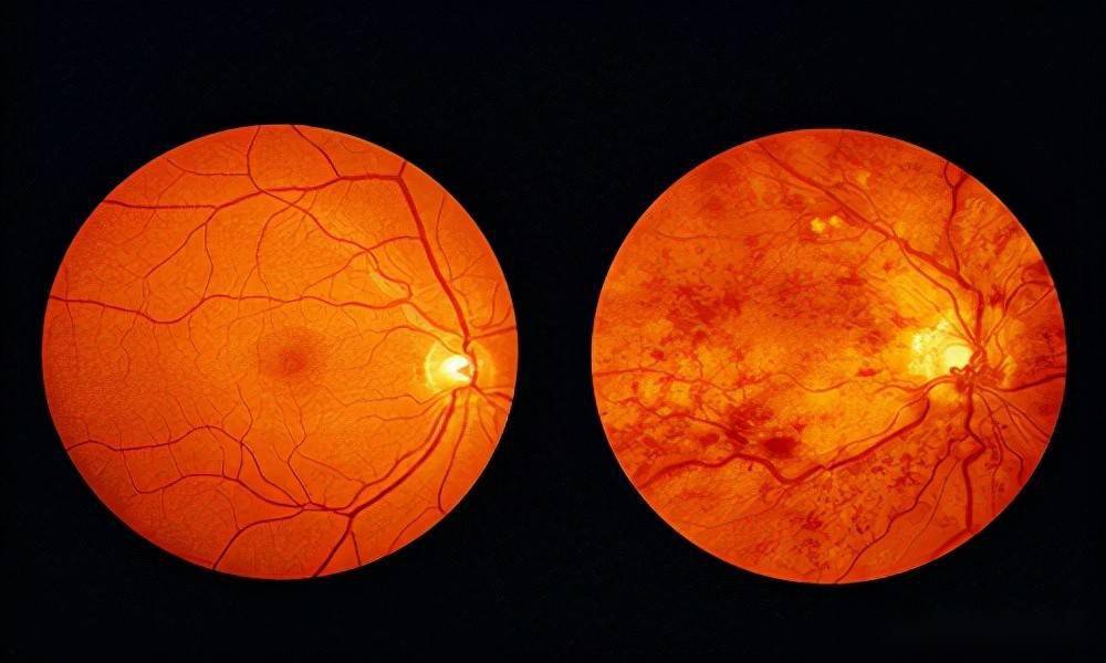 糖尿病视网膜病变牢记眼底检查避免失明的金钥匙