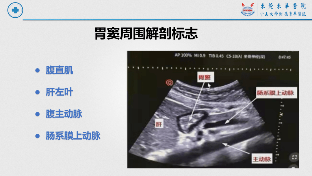 胃壁超声声像图分几层图片